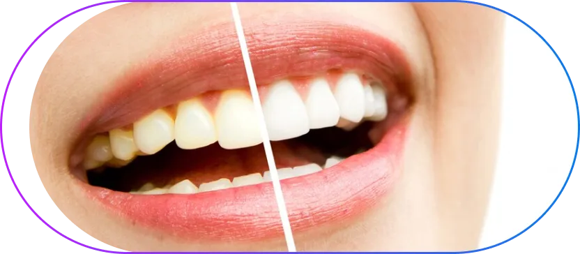 Teeth Whitening in Kolkata